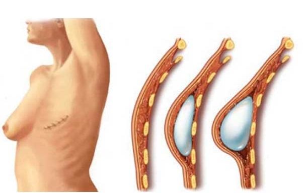 02 - بازسازی سینه بعد از برداشتن سینه به علت سرطان