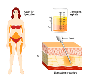 vaser liposuction procedure v2 1 300x263 - عمل لیپوساکشن | نحوه جراحی و مراقبت های بعداز عمل