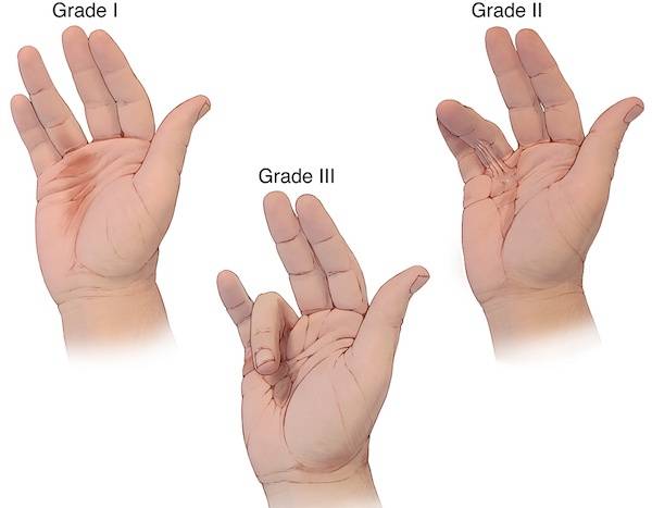 2 - آزاد کردن جمع شدگی انگشتان و اعضای بدن