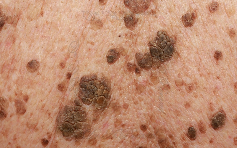 سبورئیک تومورها و سرطان های پوستی | 8 تومور شایع غیر سرطانی پوست