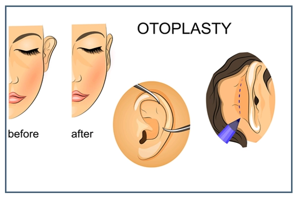 otoplasty جراحی زیبایی تنه و اندام ها | صفر تا صد جراحی زیبایی اندام