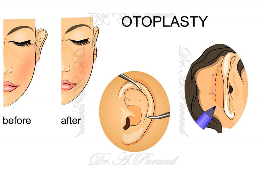 1 6 اتوپلاستی یا جراحی زیبایی گوش‌ | جدیدترین روش جراحی