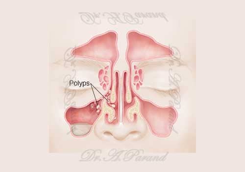 3 5 methods of nasal polyp surgery