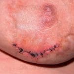 عوارض ماموپلاستی | علائم خطرناک جراحی ماموپلاستی