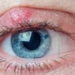 کیست پلک چشم : علت‌ها، علائم، تشخیص و درمان