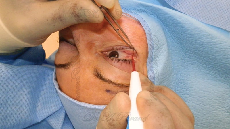images large 10.1055 s 0034 1374063 fig5 کیست پلک چشم : علت‌ها، علائم، تشخیص و درمان