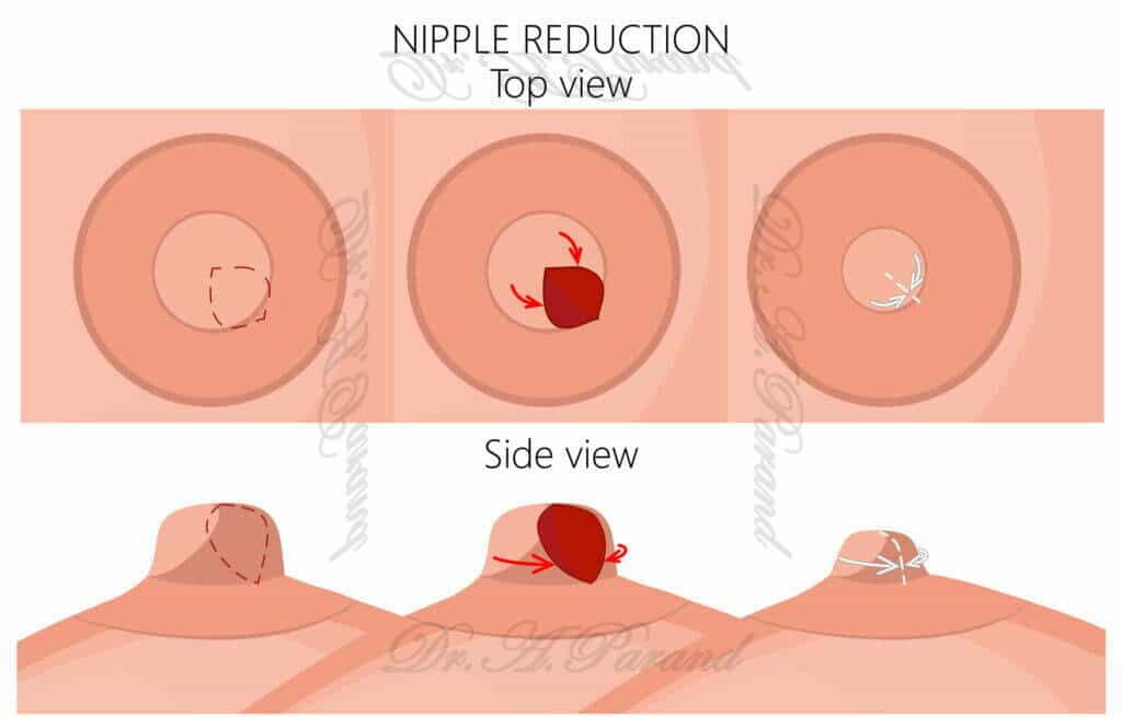 nipple reduction surgery scaled 1 1024x655 1 جراحی نوک سینه | علت ایجاد - تشخیص و درمان