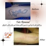 Remove the tattoo Permanent tattoo removal surgery