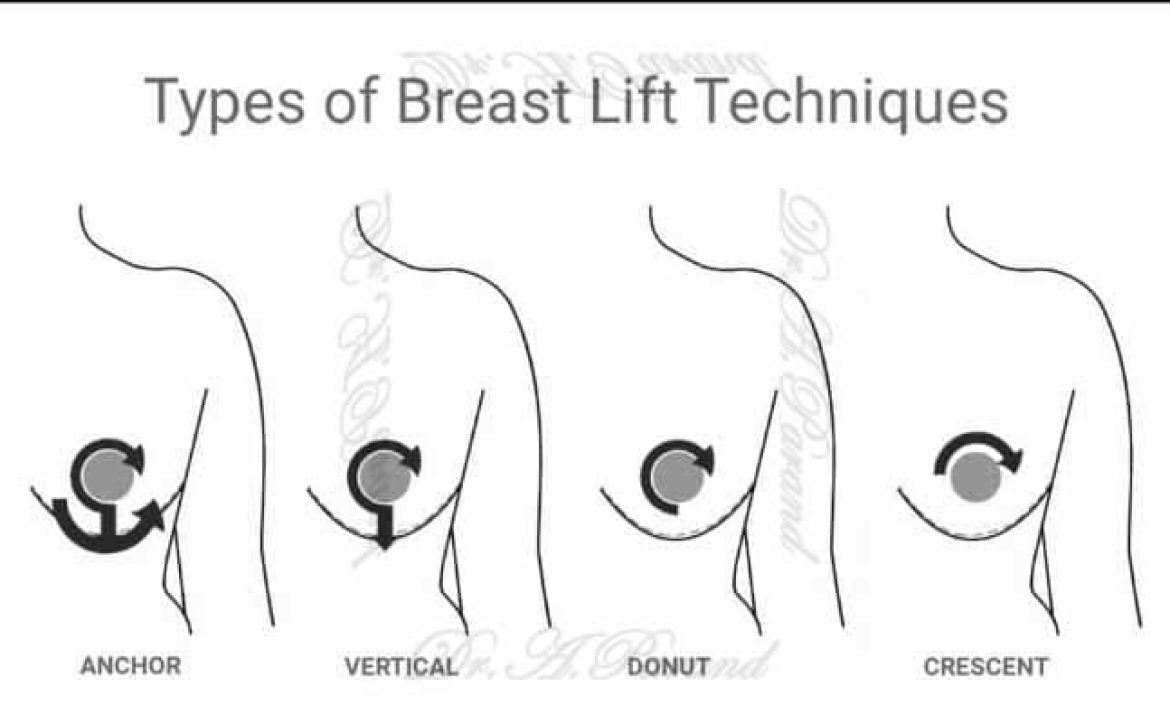 Types of Breast Lift Techniques دکتر علی پرند فوق تخصص جراحی پلاستیک زیبایی و ترمیمی