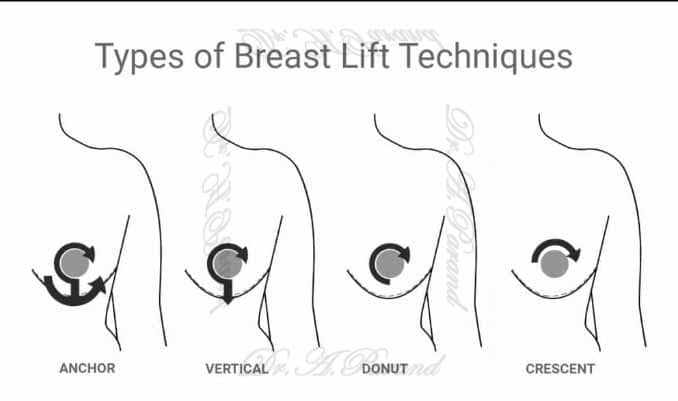 Types of Breast Lift Techniques انواع روش جراحی ماموپلاستی | برش ها - نحوه جراحی
