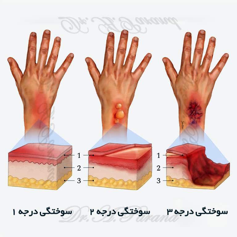 a3ajinyhwpp91 انواع درجه سوختگی در پوست | درمان دائم با جراحی پلاستیک