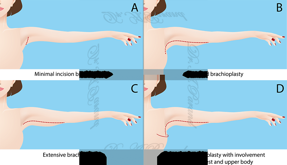 arm lift diagram the naderi center virginia 1 انواع بخیه لیفت بازو | آشنایی با روش های بخیه