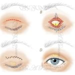Gold plate Surgery to correct non-closure of the eyelid