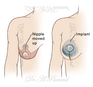 two images of female chest showing right arm and breast first figure shows incisions and tissue removed for mastopexy second f انواع روش جراحی ماموپلاستی | برش ها - نحوه جراحی