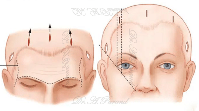 The cost of forehead lift surgery