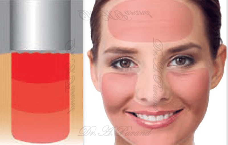 Laser forehead lift cost
