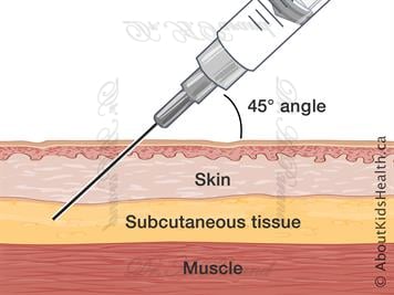 Subcutaneous fillers
