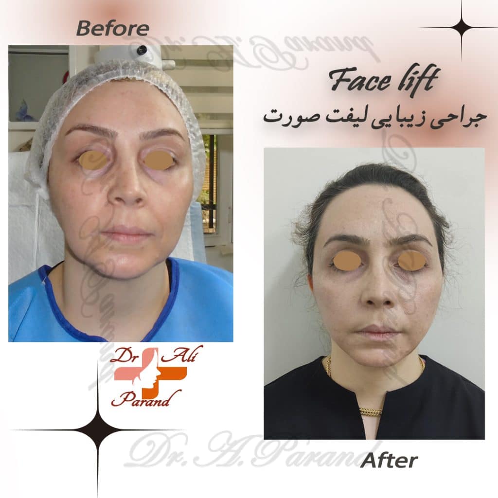 lift face 1 12 new methods of face lift without surgery The best way to lift 2024