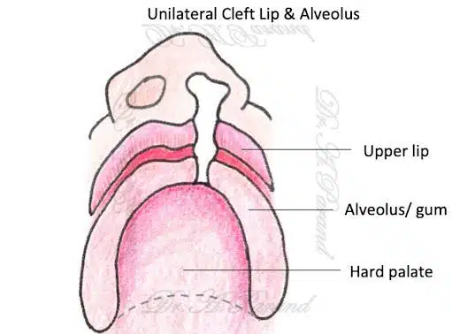 عمل شکاف آلوئولار