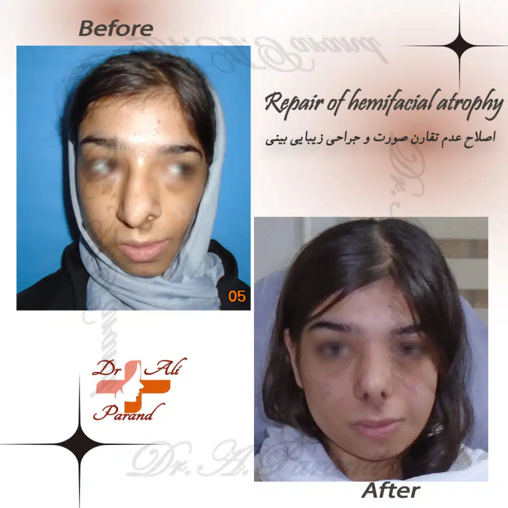 عوارض جراحی بینی 1