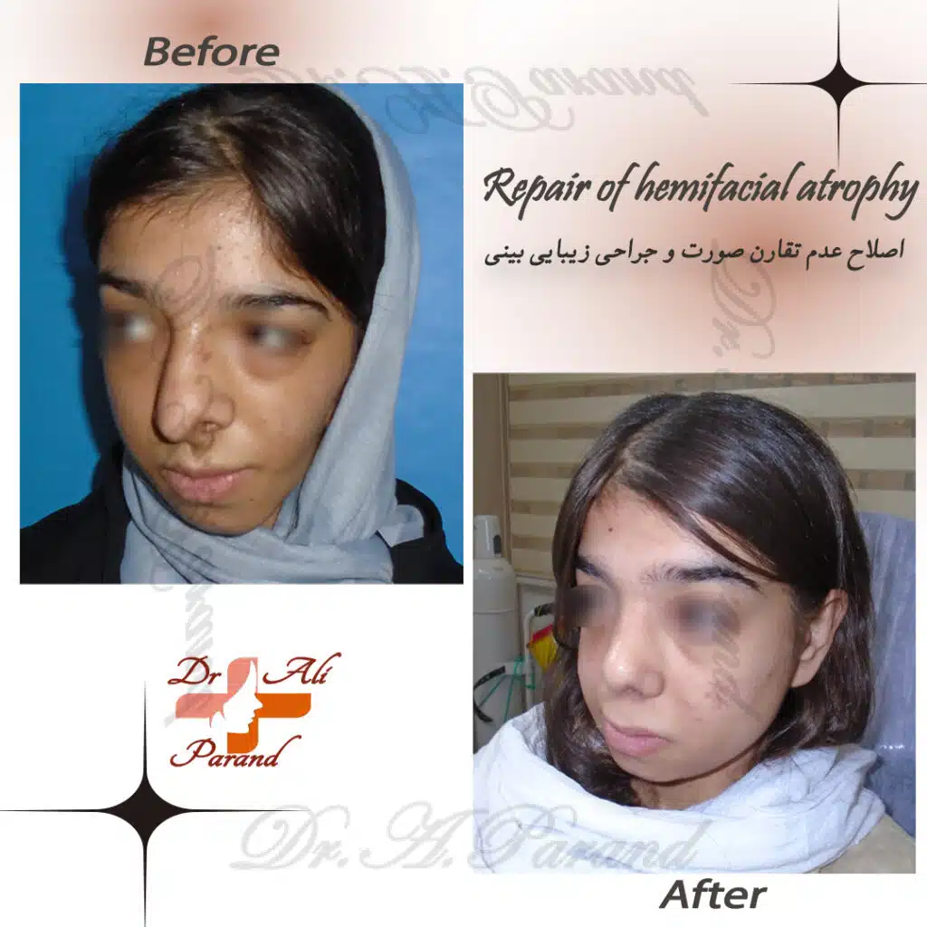 عوارض جراحی بینی 23