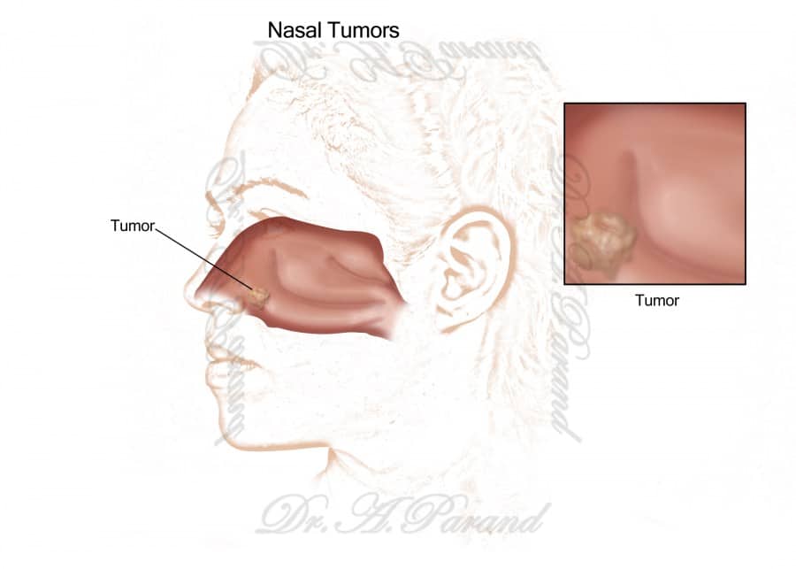 تشخیص تومور بینی