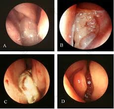 ت بینی4 تومور بینی| علائم، تشخیص و انواع روش درمان