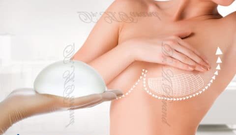 جراحی پروتز سینه