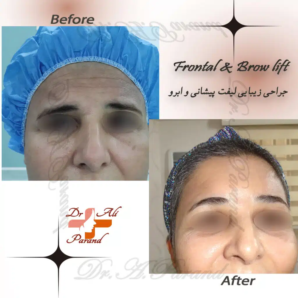 جراحی خطوط پیشانی