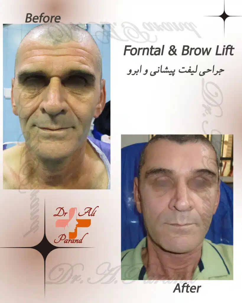 درمان خطوط پیشانی