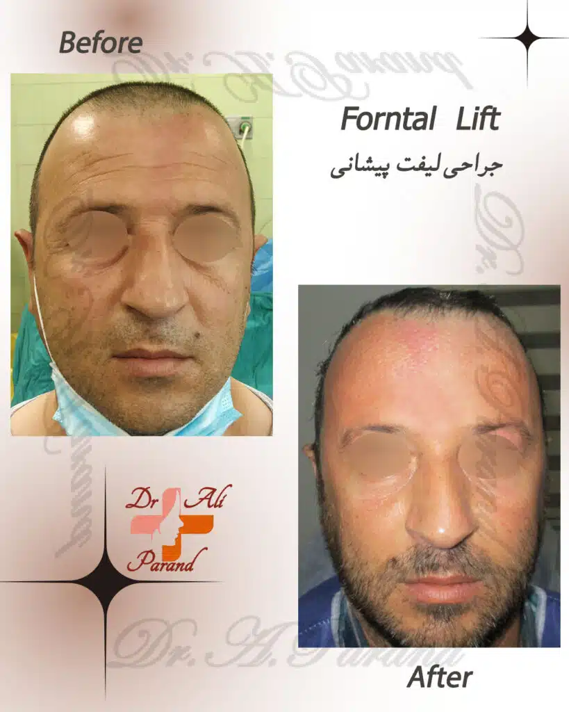 جراحی لیفت پیشانی