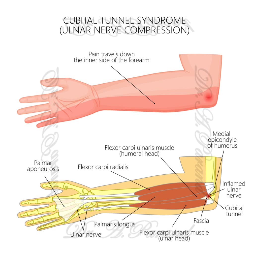 درمان عصب دست