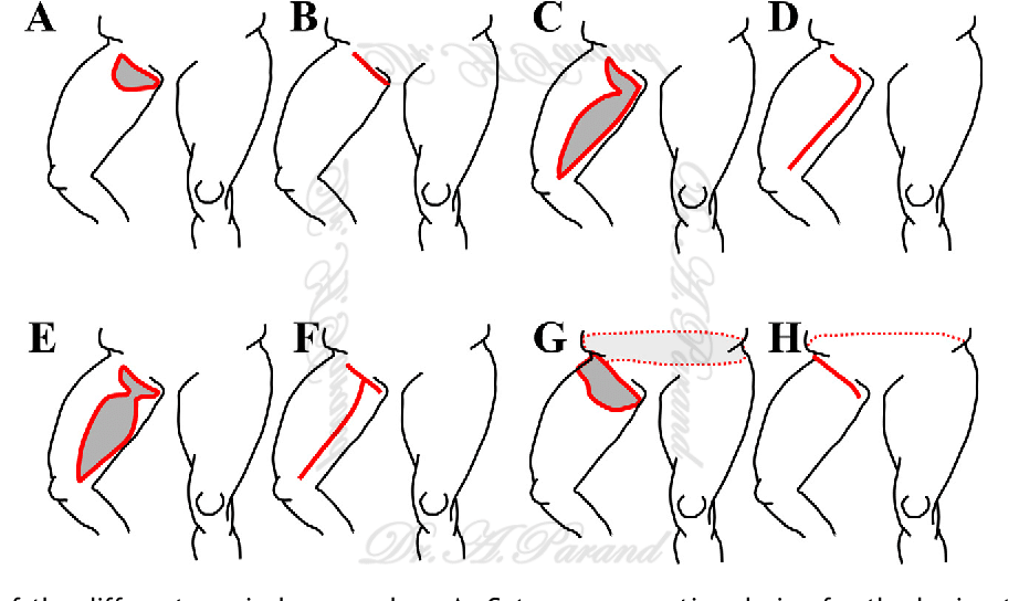 جای بخیه‌ لیفت ران