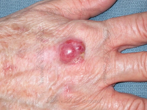 جراحی سرطان انگشت دست