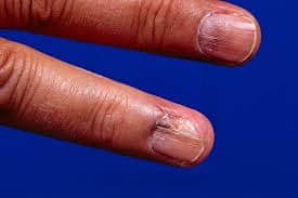 نمونه عکس سرطان انگشت دست 1