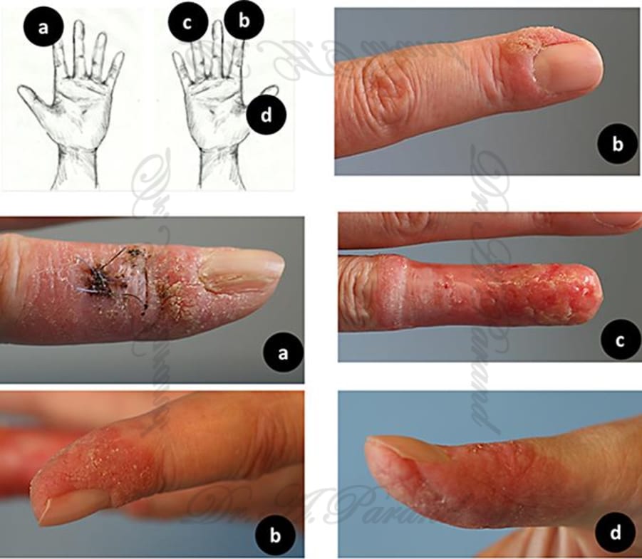 علائم سرطان انگشت دست