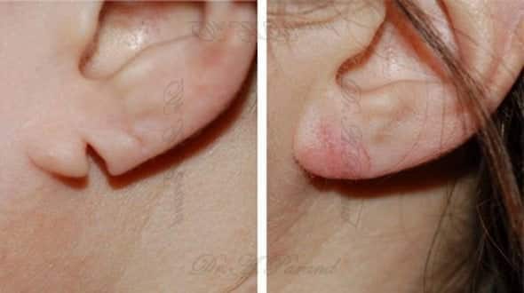 درمان پارگی لاله گوش