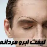 لیفت ابرو مردانه| روش‌ها، مزایا و معایب| مراقبتهای ضروری