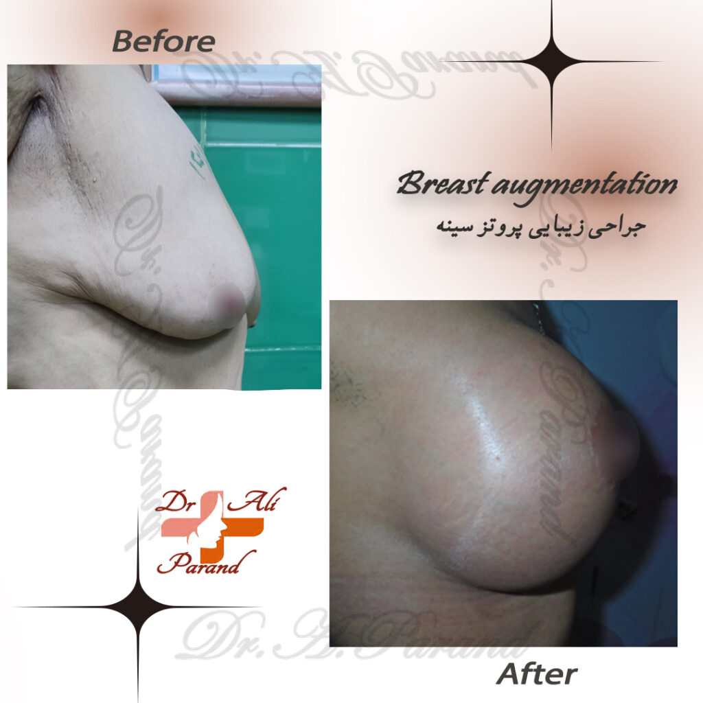 نمونه پروتز سینه 1