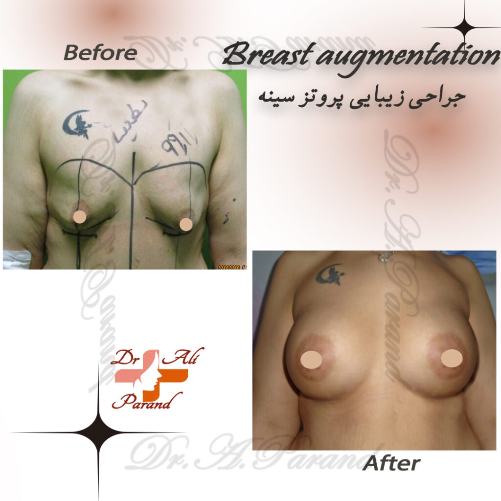 نمونه پروتز سینه 3