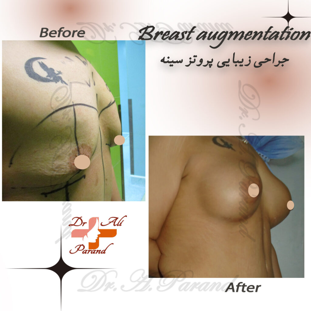نمونه پروتز سینه 2