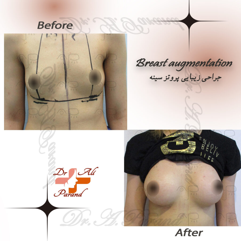 نمونه پروتز سینه 5