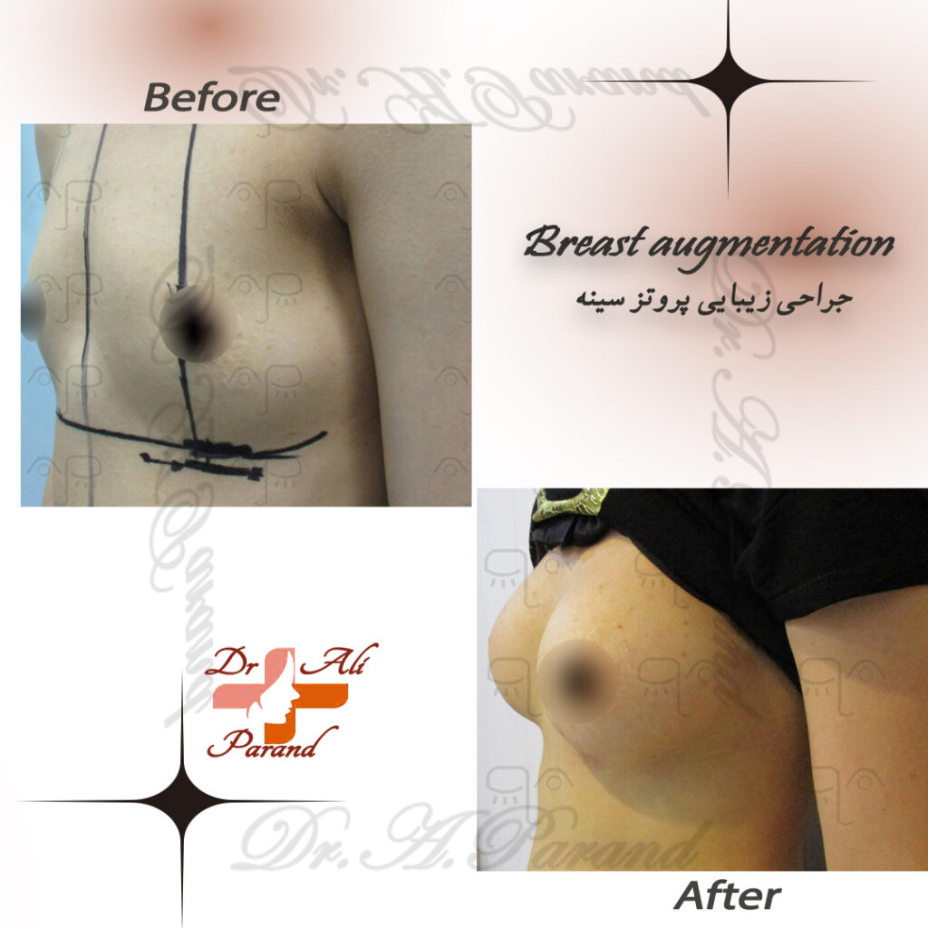 نمونه پروتز سینه 6