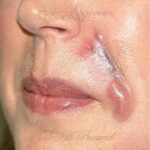 عوارض ژل پاژ و علائم خطرناک آن